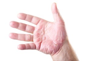 Bilde: Hva er kronisk håndeksem?